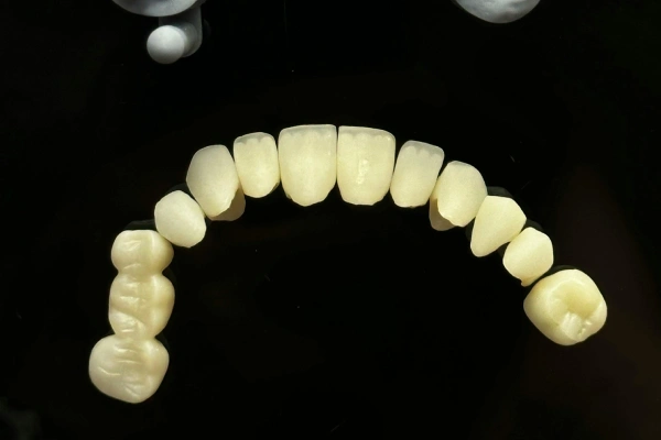 Porcelain Crown in Lakeview & Alturas